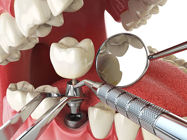 Best Emergency Denture Repair in Whitehall, MI